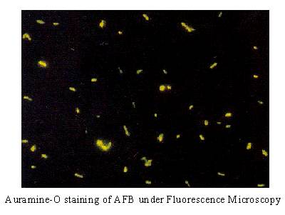 Afb Tb