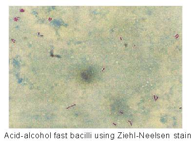 Acid-alcohol fast bacilli using Ziehl-Neelsen stain