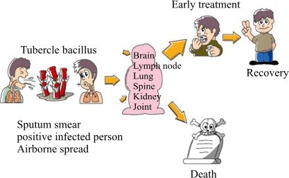 Flowchart of Tuberculosis: Tuberculosis(TB) is caused by tubercle bacillus. A sputum smear positive infected person will spread the disease through the air. TB usually affects the lung, but it can also affect other organs like lymph nodes, bones, joints, vertebral spine, brain, and kidney, etc. Prompt treatment will lead to recovery. If it is not treated, it may lead to death.