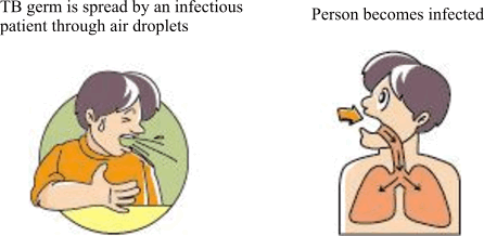 Tuberculosis germ is spread by an infectious patient through air droplets -> Person becomes infected