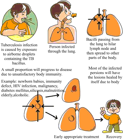 After infected by tubercle bacilli: Tuberculosis infection is caused by exposure to airborne droplets containing the TB bacillus. Person infected through the lung. Bacilli passing from the lung to hilar lymph node and then spread to other parts of the body. A small proportion will progress to diesease due to unsatisfactory body immunity. Example: newborn babies, immunity defect, HIV infection, malignancy, diabetes mellitus, silicosis, malnutrition, elderly, alcoholic. Most of the infected persons will have the lesions healed by itself due to body. Early appropritate treatment will lead to recovery.
