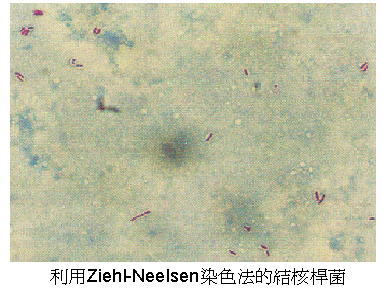 利用Ziehl-Neelsen染色法的结核杆菌